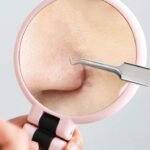 6-Pieces Set: Blackhead Remover Comedones Extractor Acne Removal Kit - Image 8